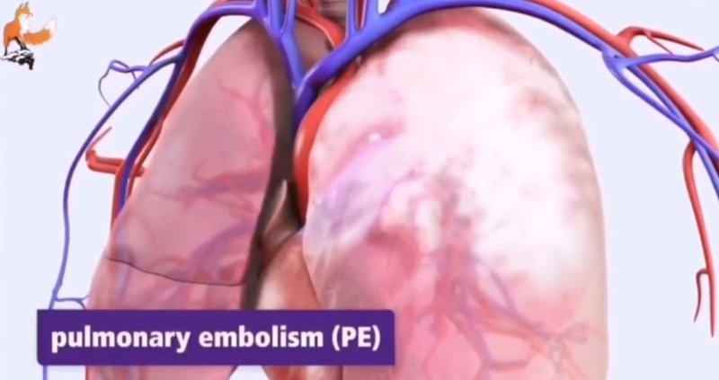hypertension-arterielle-dans-les-poumons-des-injectes-covid-qui-manquent-de-souffle.JPG