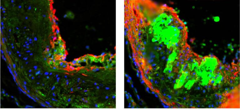 Par rapport aux souris qui n’ont jamais consommé l’édulcorant (à gauche), les souris nourries à l’aspartame (à droite) ont montré des muscles lisses endommagés (rouge) et une présence accrue de cellules immunitaires (vert) dans leurs artères, indiquant des signes précoces de problèmes cardiovasculaires. Crédit : Wu et al., Cell Metabolism