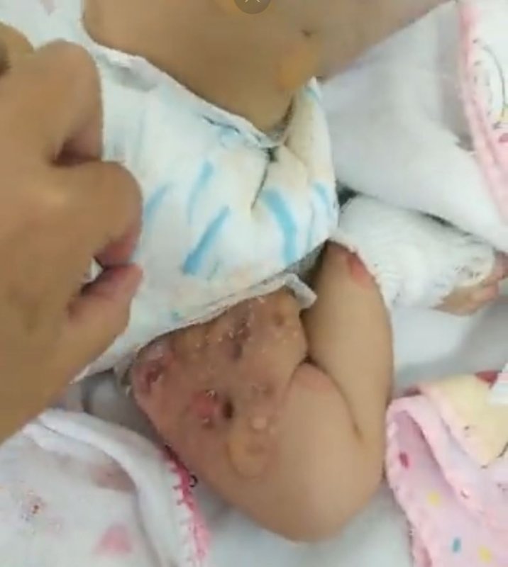 bebe-blesse-suite-a-la-vaccination-de-sa-mere.JPG