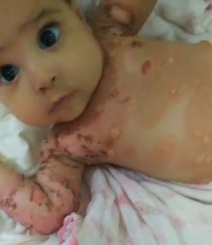 bebe-bresilien-blesse-suite-a-la-vaccination-de-sa-mere-qui-l-a-allaite.JPG