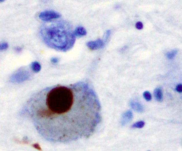 Cette image microscopique montre un corps de Lewy (amas d'alpha-synucléine) dans un neurone, typique de la LBD.<br /><br />Source: https://fr.wikipedia.org/wiki/Alpha-synucl%C3%A9ine