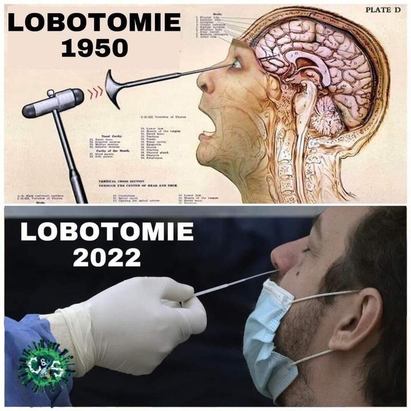 la-lobotomie-de-1950-a-2022-demeure-un-crime-contre-les-humains.jpeg