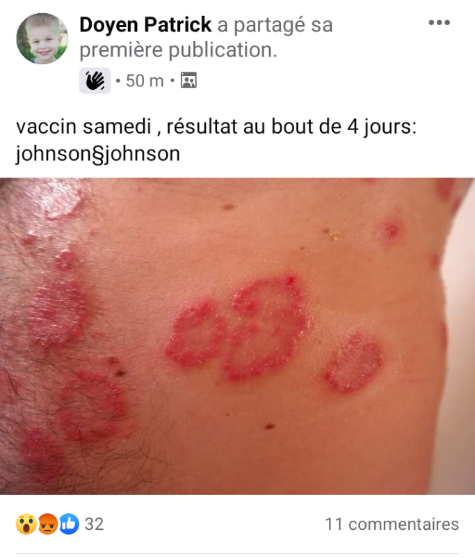 4-jours-apres-le-vaccin-covid-de-janssen.png