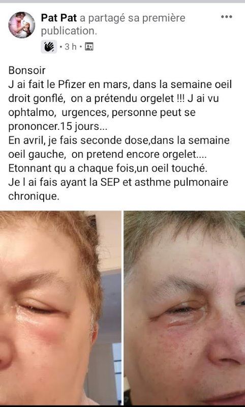 gonflement-des-yeux-apres-kes-vaccinations-pfizer.jpg