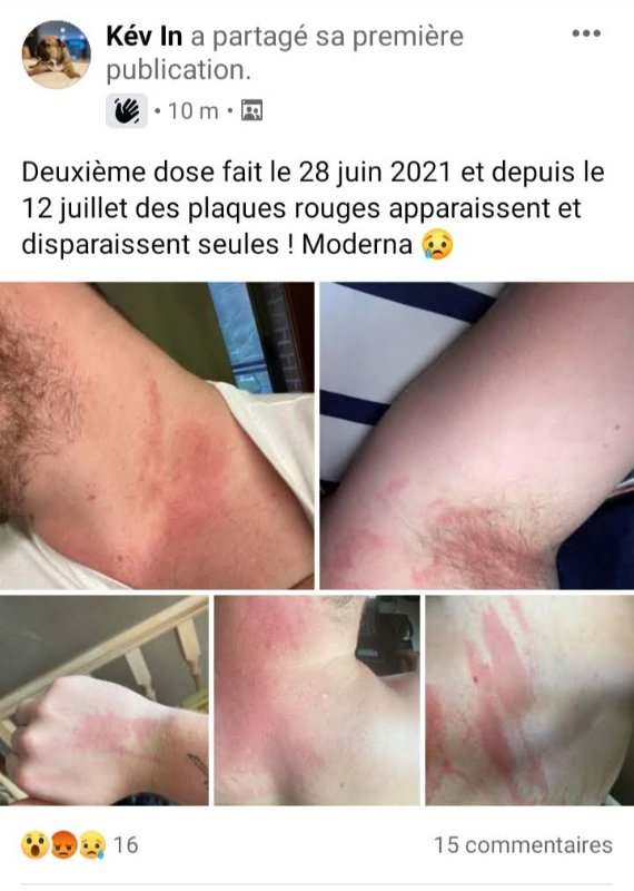 plaques-rouges-suite-a-l-injection-de-moderna.jpg