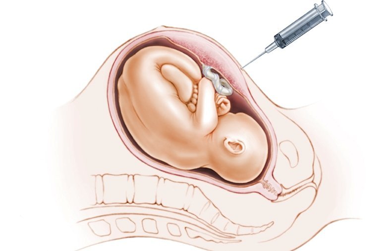 l-injection-directement-dans-le-vendtre-de-la-mere.jpg