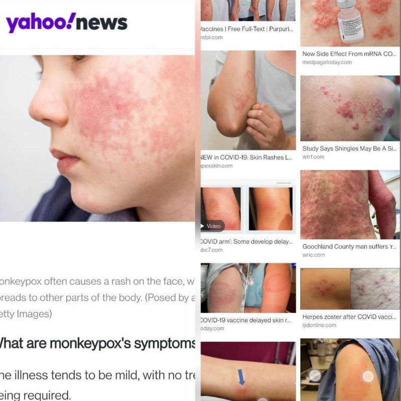 comparaison-de-la-variole-simienne-et-des-effets-des-vaccins-covid-sur-laa-peau.jpg