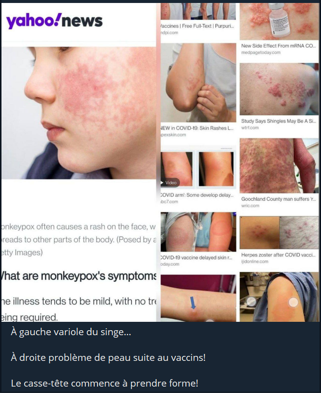 la-variole-simienne.png