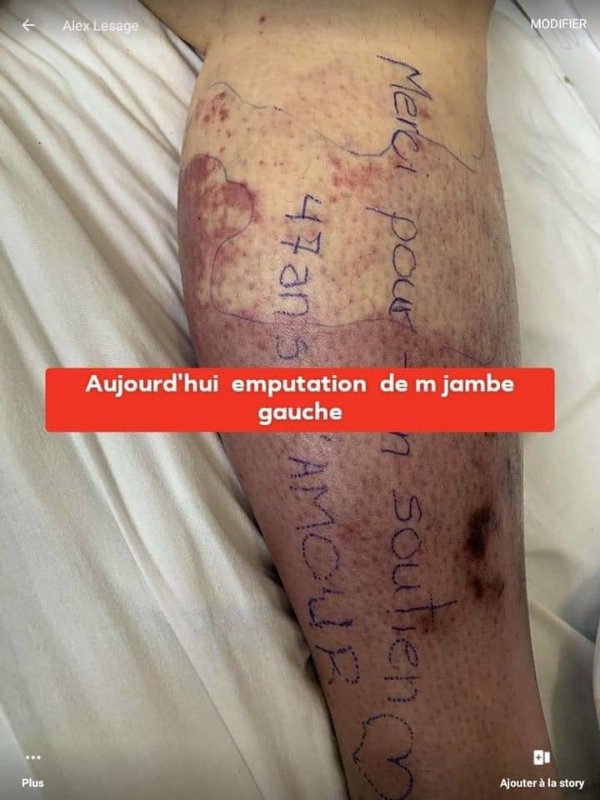 amputation-de-la-jambe-gauche-d-isabelle-martel.jpg