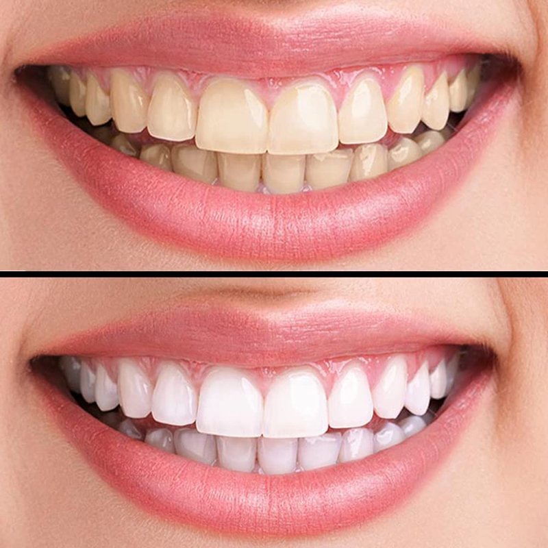 dents-blanches-avec-du-peroxyde-3-pc-10-mins.jpg