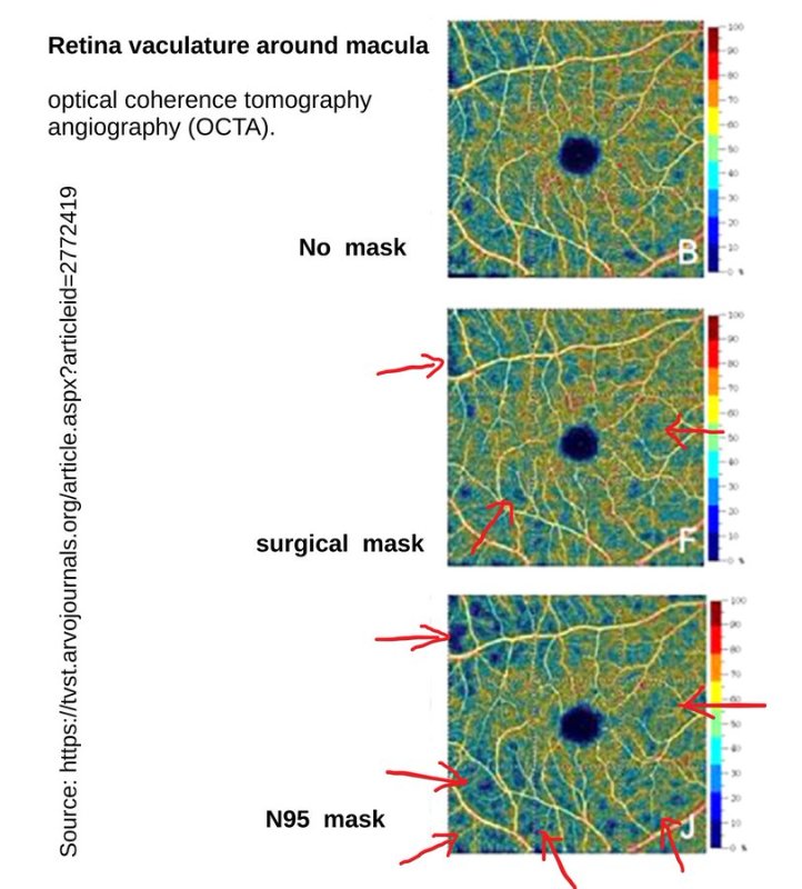 risque-de-lesion-retinienne-en-cas-de-port-du-masque.jpg