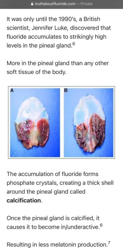 calcification-de-la-glande-pineale.jpg