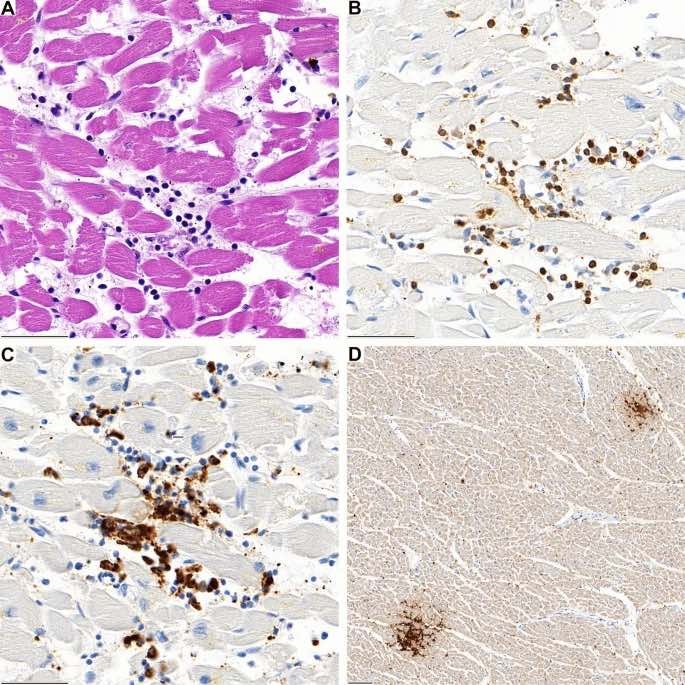A Agrégats lymphocytaires dans le septum interventriculaire du cas 1 avec destruction associée des myocardiocytes. B L'infiltrat est majoritairement composé de lymphocytes T CD3 positifs et C de macrophages CD68 positifs. D À faible grossissement, deux foyers de lymphocytes CD4-positifs sont évidents ( D )
