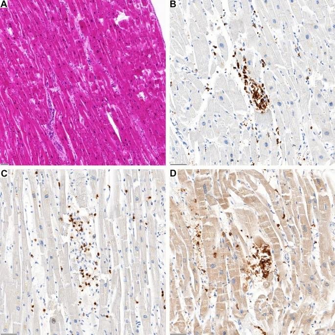 A Foyer inflammatoire dans la paroi ventriculaire gauche du cas 2. B L'infiltrat est majoritairement composé de macrophages CD68 positifs et C de lymphocytes T CD3 positifs avec ( D ) co-expression de CD4
