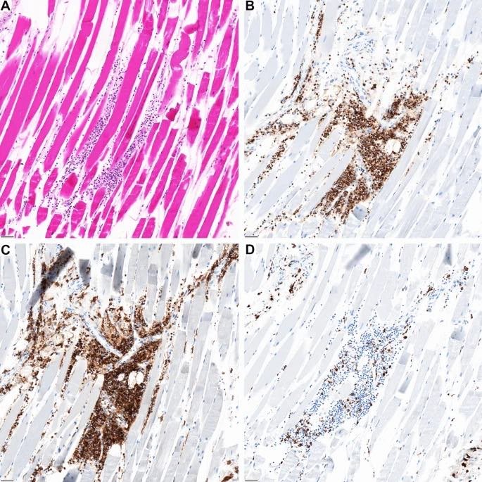 A Le site de piqûre dans le muscle deltoïde révèle une inflammation focale. La composition est similaire au phénotype des infiltrats myocardiques montrant principalement des lymphocytes B CD3 et C CD4 co-exprimant et D des macrophages CD68 positifs intercalés.